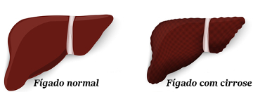 Observe a diferença entre um fígado normal e com cirrose