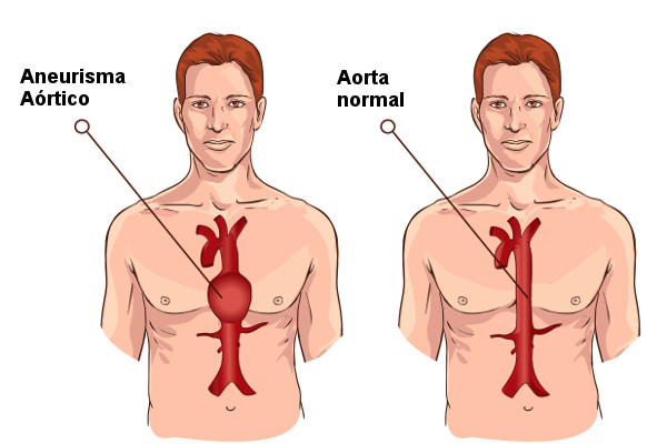 No aneurisma aórtico, observa-se a dilatação anormal da aorta.