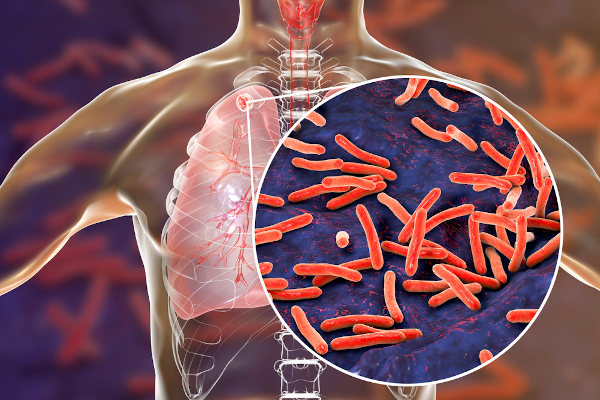 A tuberculose é uma doença causada por um bacilo que acomete, principalmente, os pulmões.