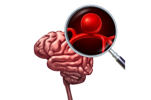 O aneurisma cerebral ocorre mais na forma de aneurisma sacular.