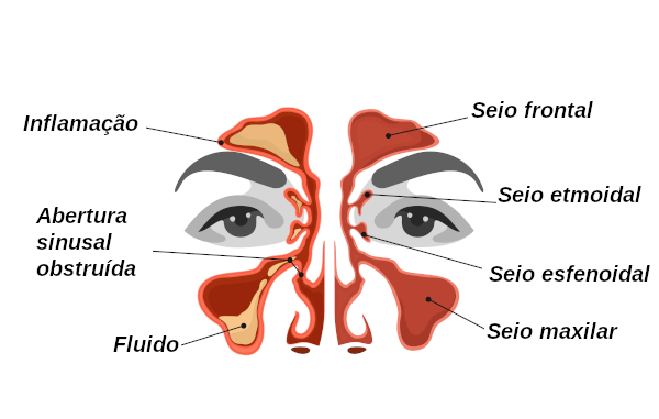  Na sinusite observa-se a inflamação dos seios da face.