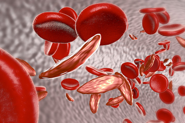 Hemácias em formato de foice em referência à anemia falciforme.