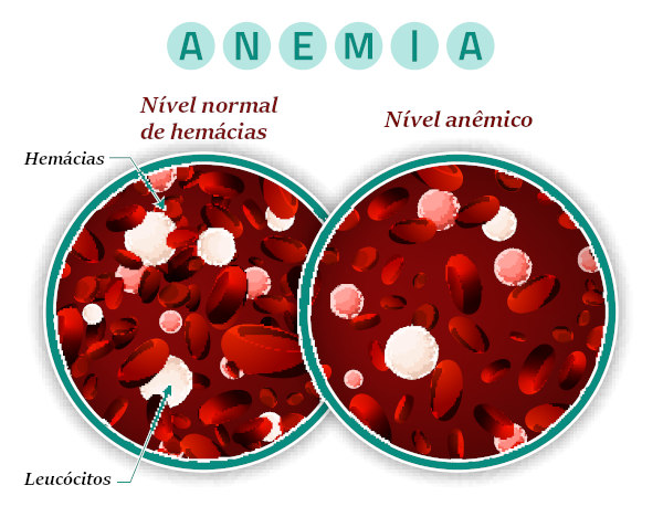 Ilustração representando a diminuição das hemácias, causa da anemia.