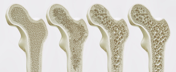 Ilustração dos ossos com osteoporose.