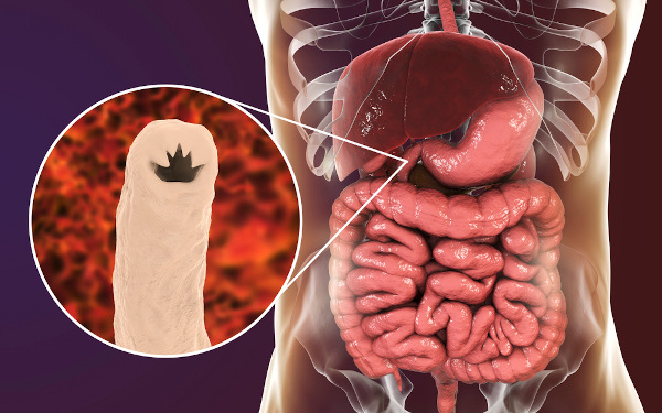  Os vermes causadores da ancilostomíase se fixam no intestino delgado, onde se alimentam e se reproduzem.
