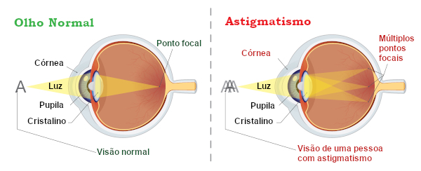O astigmatismo pode ocorrer como consequência de um formato irregular da córnea.