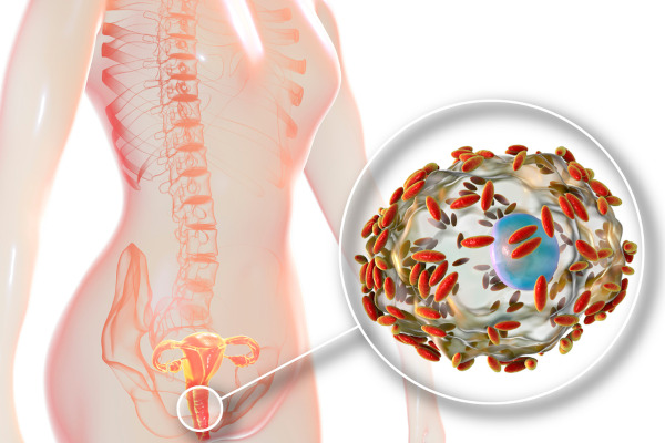 Representação da bactéria Gardnerella vaginalis no corpo da mulher.