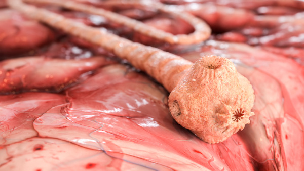 Teníase no intestino em referência à cisticercose.