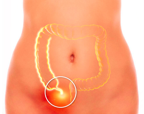 Apendicite é uma inflamação que atinge o apêndice.