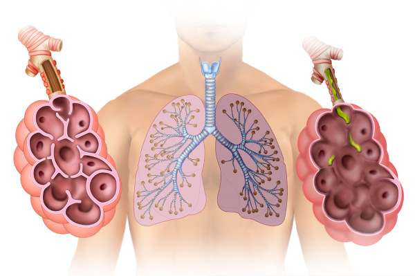 enfisema pulmonar, as paredes alveolares são destruídas, comprometendo-se a captação de oxigênio.