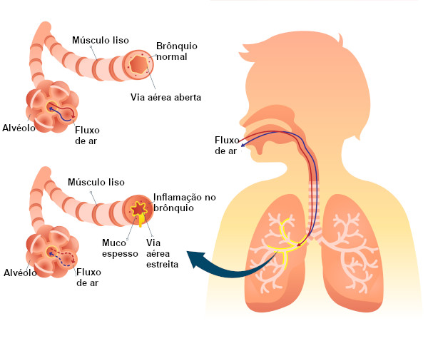  A inflamação dos brônquios é denominada bronquite.