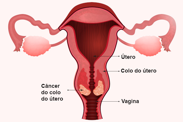 Observe a estrutura do útero e onde o câncer do colo do útero se desenvolve.