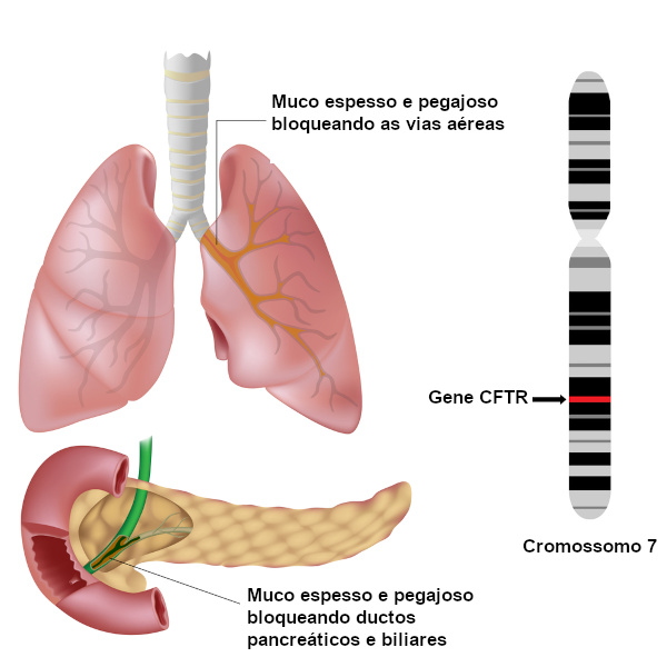 A fibrose cística afeta um gene do cromossomo 7.