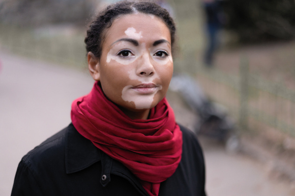 O vitiligo caracteriza-se pelo surgimento de lesões cutâneas de hipopigmentação.