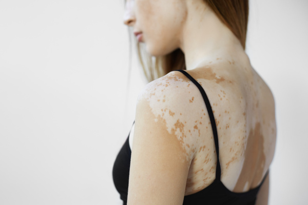 Muitas pessoas apresentam uma queda na autoestima devido ao vitiligo.