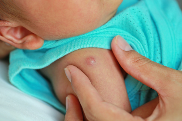 Lesão causada pela vacina BCG em um bebê.