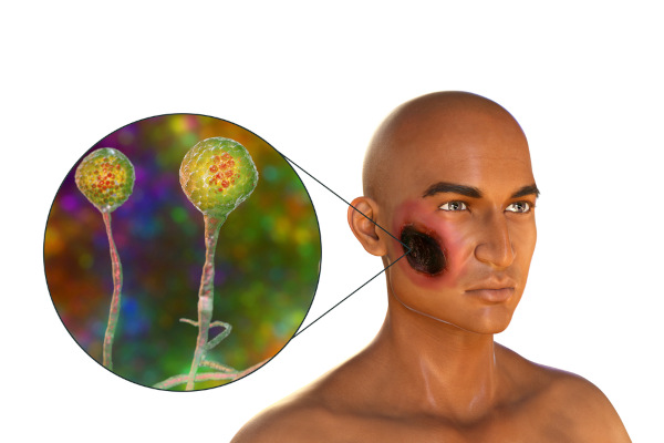 A mucormicose pode provocar necrose da pele e palato.