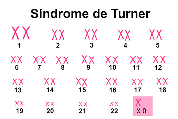Análise de cariótipo da síndrome de Turner.