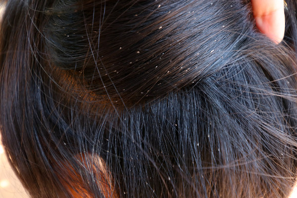 Ovos de piolho em cabelo de criança