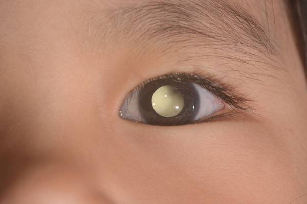 A leucocoria, também conhecida como sinal do olho de gato, pode ser um sintoma de retinoblastoma.