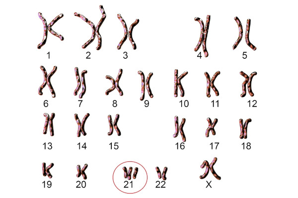 Ilustração do cariótipo de síndrome de Down, a trissomia do cromossomo 21.