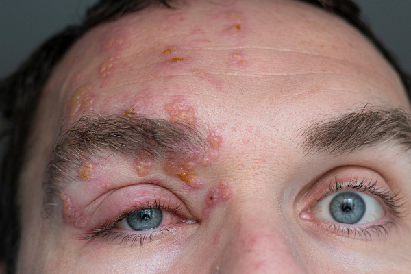 Pessoa com lesões provocadas pelo herpes-zóster na região dos olhos.