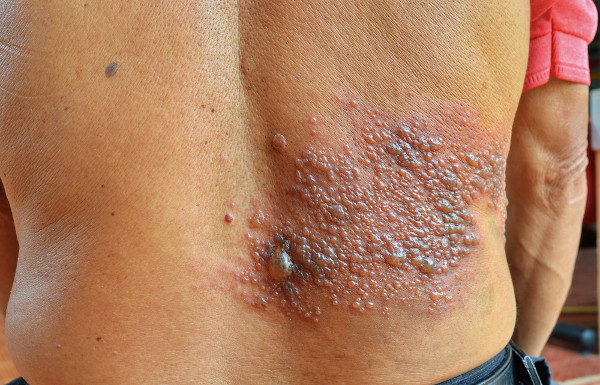 Pessoa com a lateral direita das costas com lesões causadas pelo vírus causador do herpes-zóster.