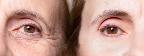 Representação da ideia do antes e depois de aplicações de toxina botulínica, muito conhecida como botox.