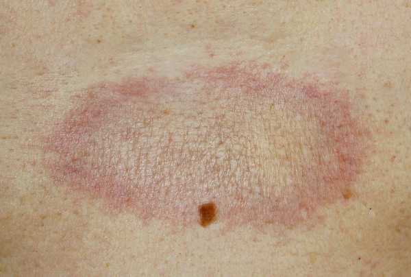 Esclerodermia localizada em região do abdome