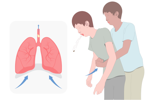 Ilustração representando a manobra de Heimlich, utilizada em casos de engasgo.