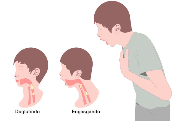 Ilustração representando uma pessoa engasgando.