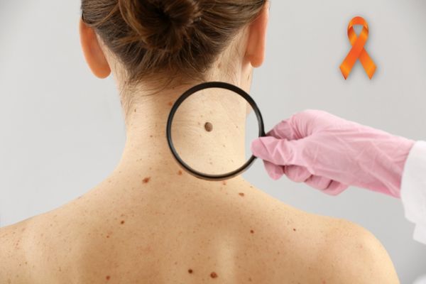 Pessoa segura lupa que mostra a pinta de uma mulher branca Dezembro Laranja Câncer de pele