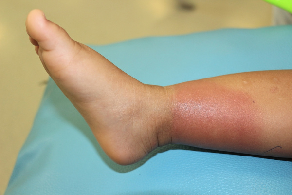 Vista aproximada da perna inchada e vermelha de uma pessoa com erisipela.