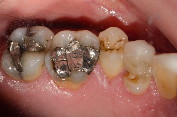  Vista aproximada de amálgama de mercúrio nos dentes de uma pessoa sendo utilizada para corrigir fraturas.