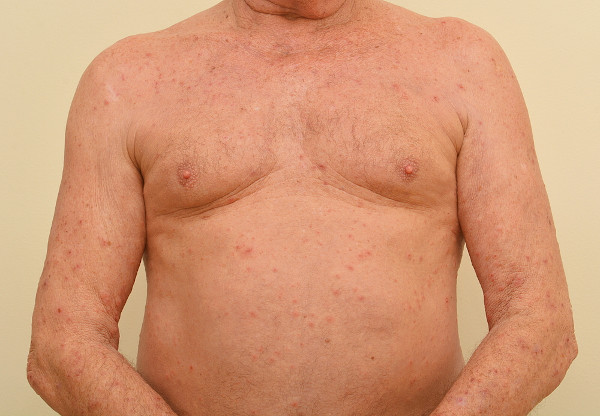 Lesões da sarna espalhadas pela parte superior do corpo.