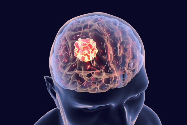 Ilustração 3D da parte superior de uma pessoa representando tumor característico de câncer de cérebro.