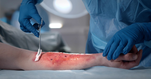 Médico realizando procedimento em uma lesão de queimadura feita no antebraço.