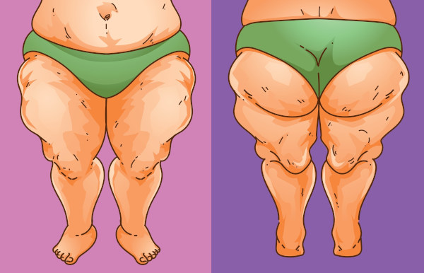 Pernas de pessoa com lipedema