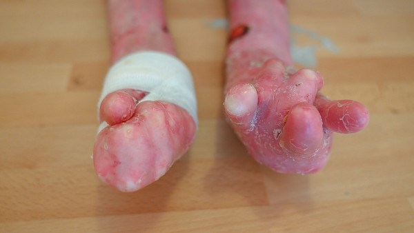 Mãos de uma criança com epidermólise bolhosa, com uma deformidade conhecida como “luva de boxe”.