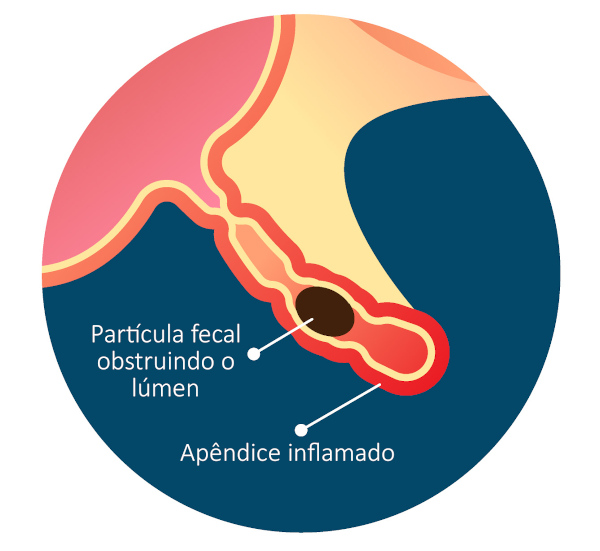 Ilustração de fezes causando obstrução no apêndice.