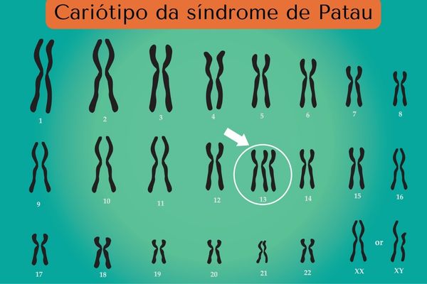Cariótipo de uma pessoa com síndrome de Patau.