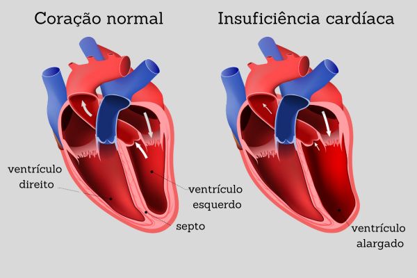 Coração normal e coração aumentado devido à insuficiência cardíca.