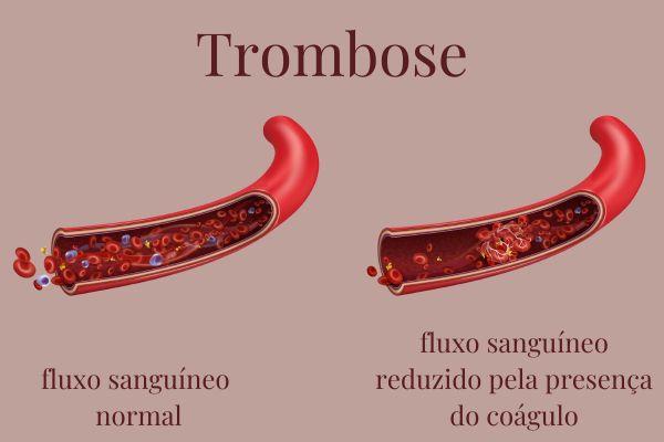 Ilustração mostrando como é um vaso sanguíneo com fluxo normal e como é um vaso sanguíneo com coágulo (trombose).