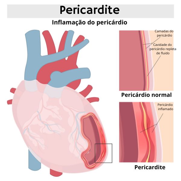 Esquema ilustrativo mostra coração afetado por pericardite.
