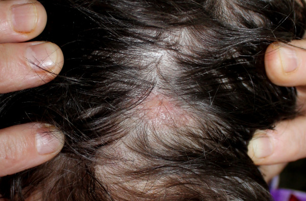 Região com perda de cabelo em couro cabeludo em decorrência de líquen plano.