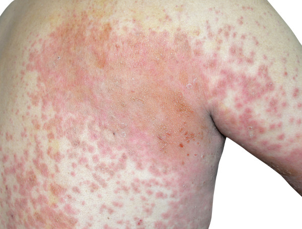 Lesões da dermatite atópica na pele.