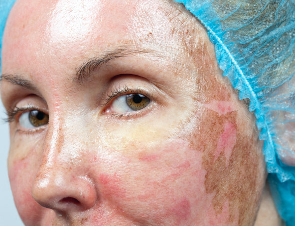 Imagem aproximada do rosto de uma mulher pouco tempo após a realização de peeling com fenol.