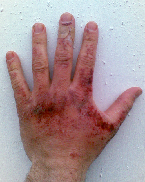 Queimaduras no dorso de uma mão, causadas por soda cáustica.