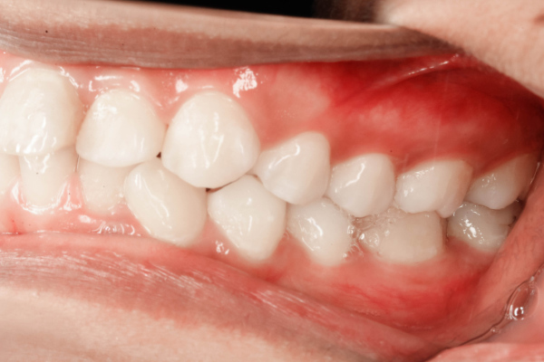 Boca saudável com saliva entre os dentes.