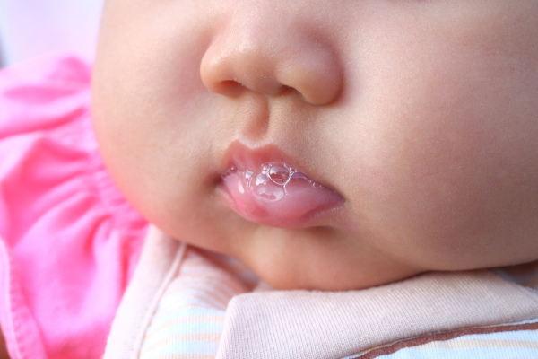Imagem aproximada do rosto de um bebê com acúmulo de saliva na boca. 